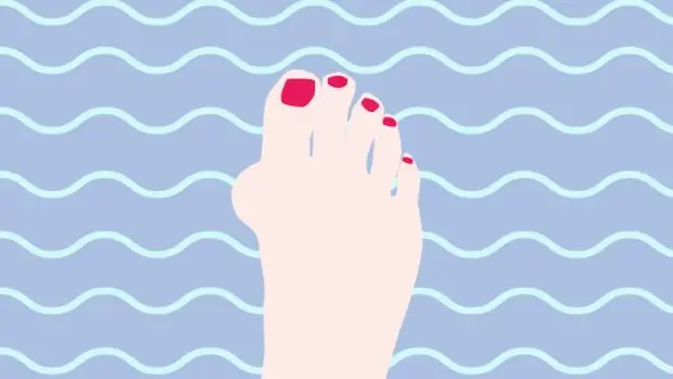 Буньоны. Что это такое и как от них избавиться