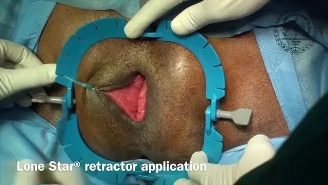 Что такое метод ДеЛорма?